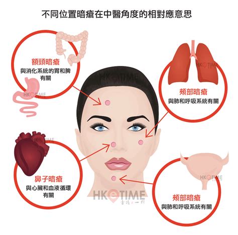 額頭 暗瘡|【暗瘡位置】不同代表什麼？中醫教如何處理及預防